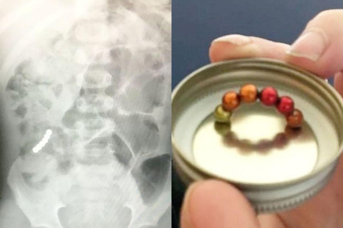 As bolinhas eram de imã e se juntaram dentro do estômago do menino causando a perfuração