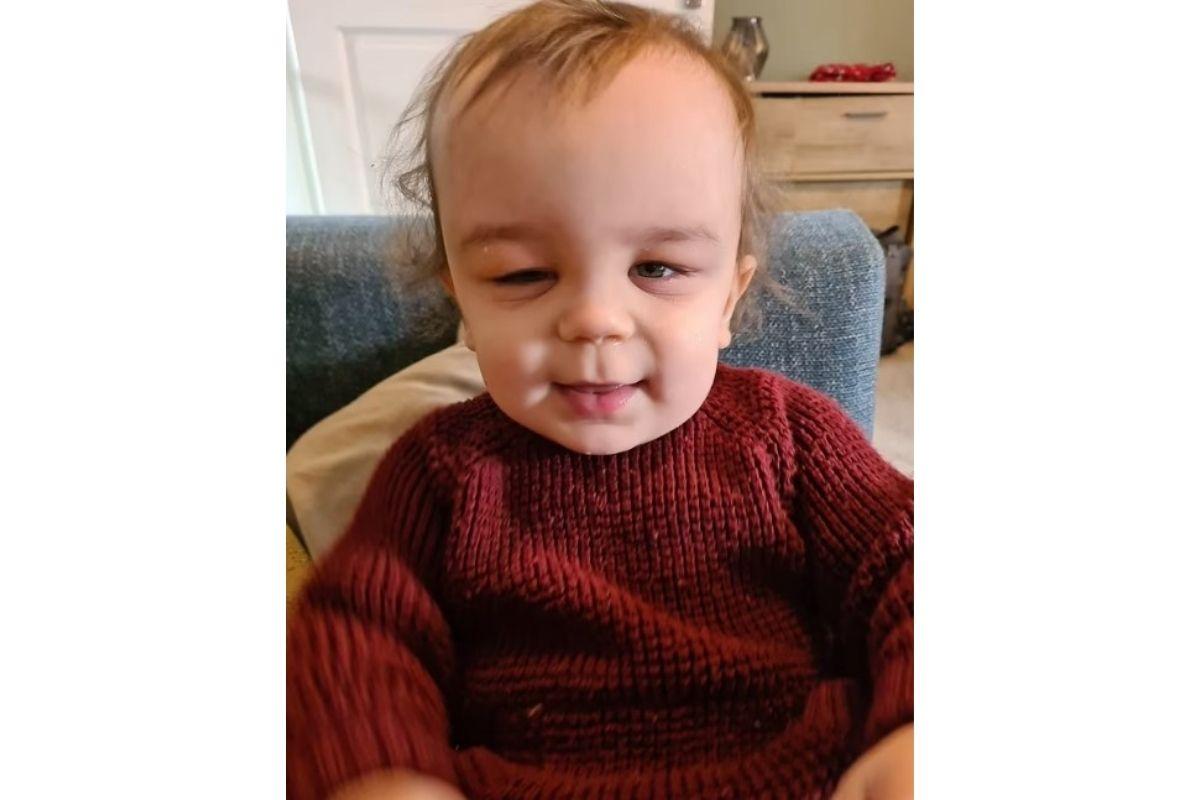 O bebê passou por uma cirurgia de 10 horas para remodelar o crânio