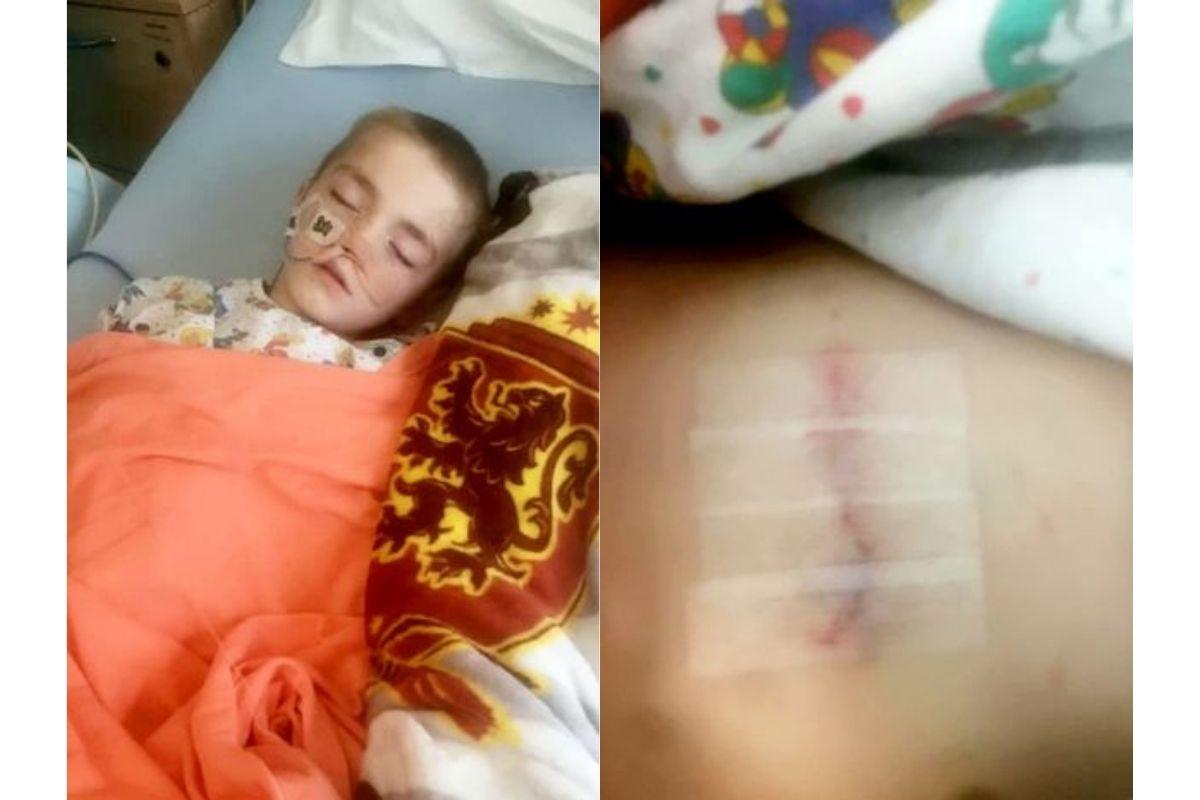 Mickey ficou com uma cicatriz após a cirurgia de remoção de metais