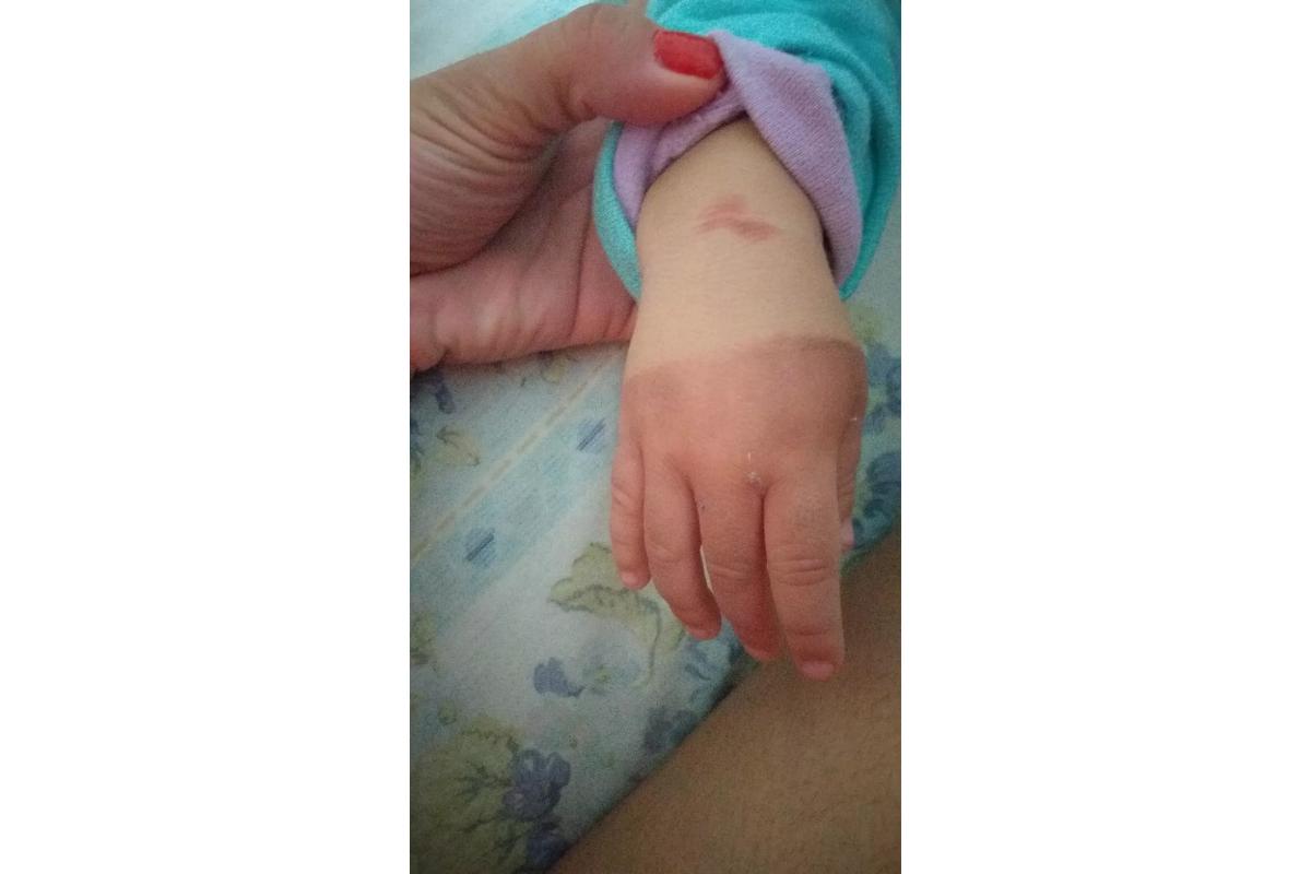A queimadura da bebê foi comprovada por laudo médico