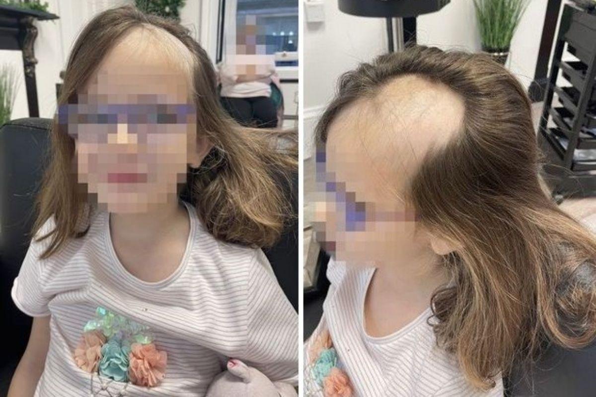 A menina perdeu boa parte do cabelo no acidente