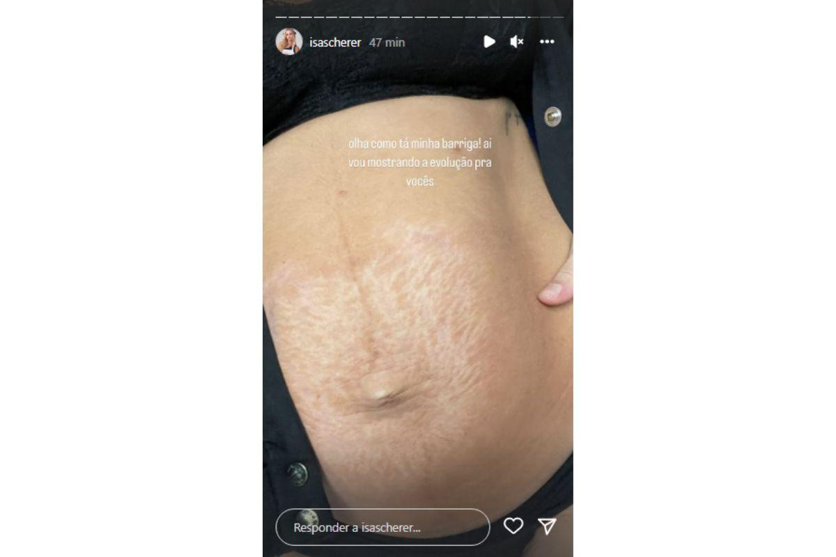 Isabella Scherer compartilhou com os seguidores como a barriga ficou após a primeira sessão de tratamento para as estrias e flacidez