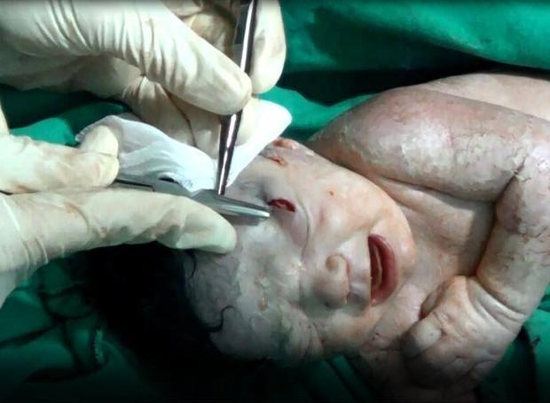 Estilhaço sendo retirado da teste da menina recém-nascida