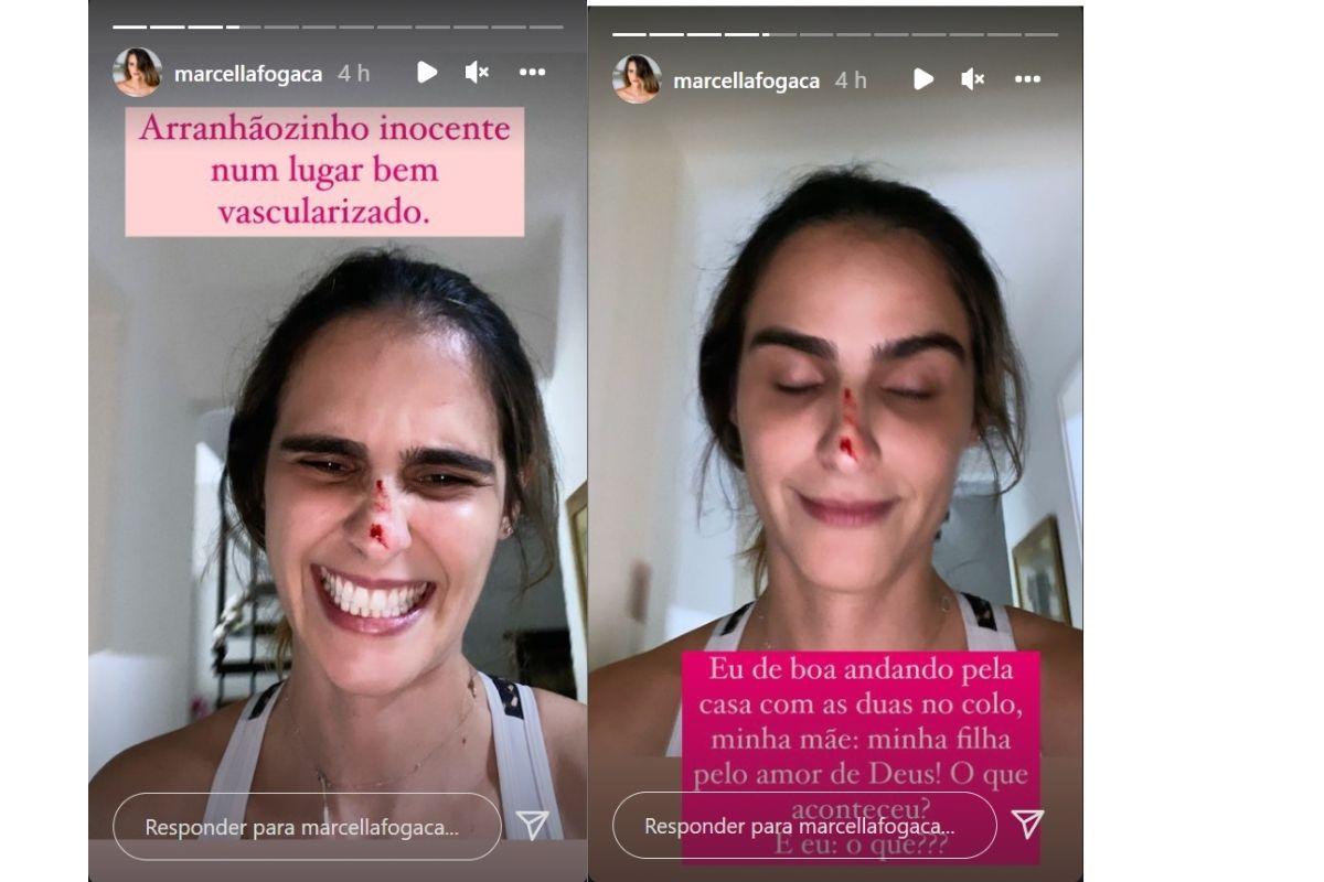 Marcella Fogaça mostra pequeno arranhão que recebeu das filhas
