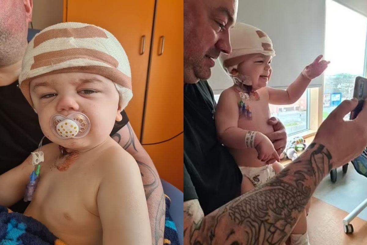 O bebê nasceu com um condição rara chamada 'cranioestenose'
