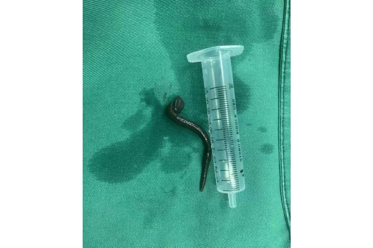Uma sanguessuga de 15 cm foi encontrada na garganta de uma menina chinesa de 5 anos
