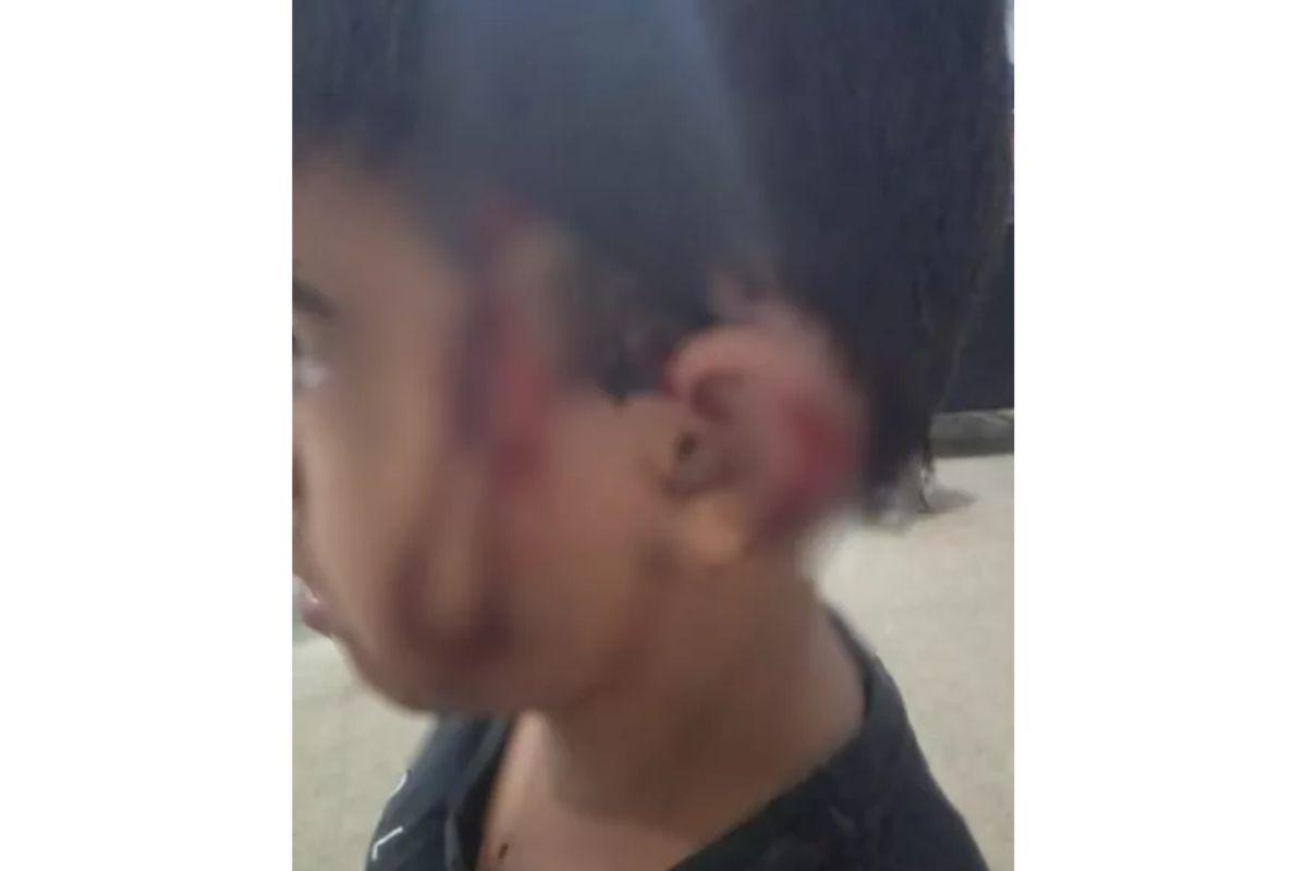 Criança perde parte da orelha ao ser atacado por cadela