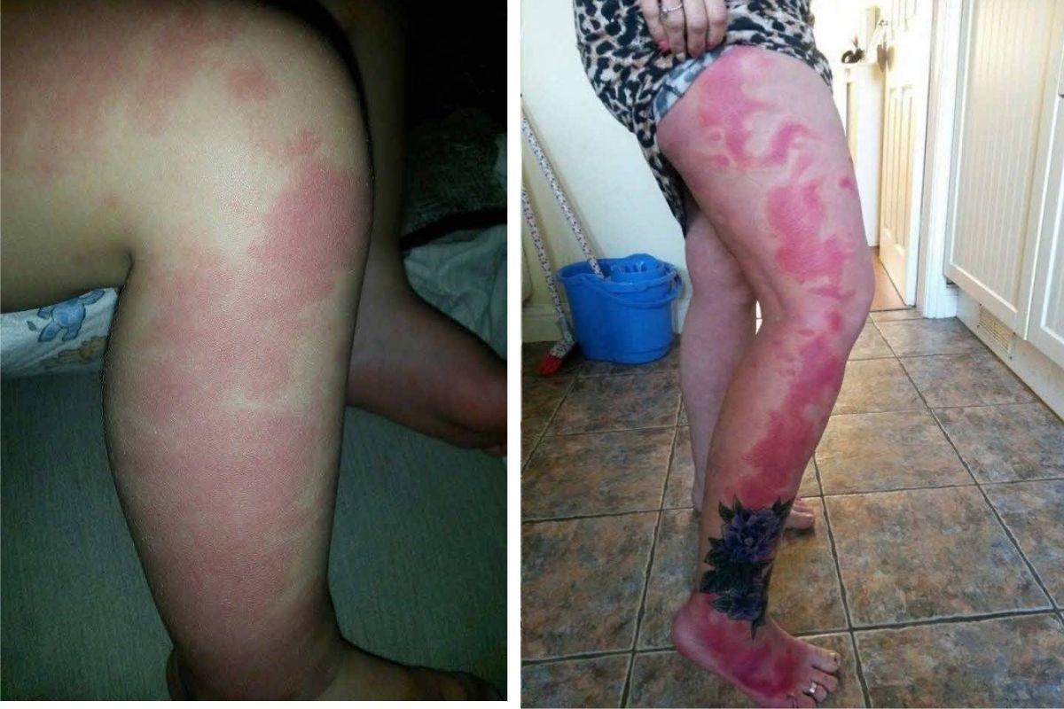 Pais tatuam marca de nascença da filha na perna para que ela se sinta mais bonita