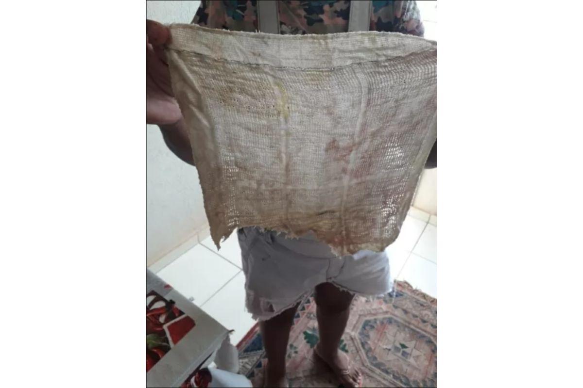 Mulher encontra pedaço de pano esquecido dentro do corpo 6 meses após cesárea