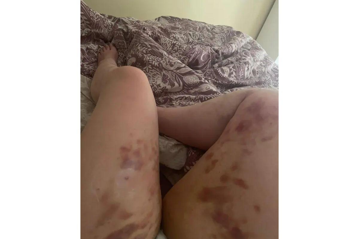 Tracy está se recuperando da picada de aranha