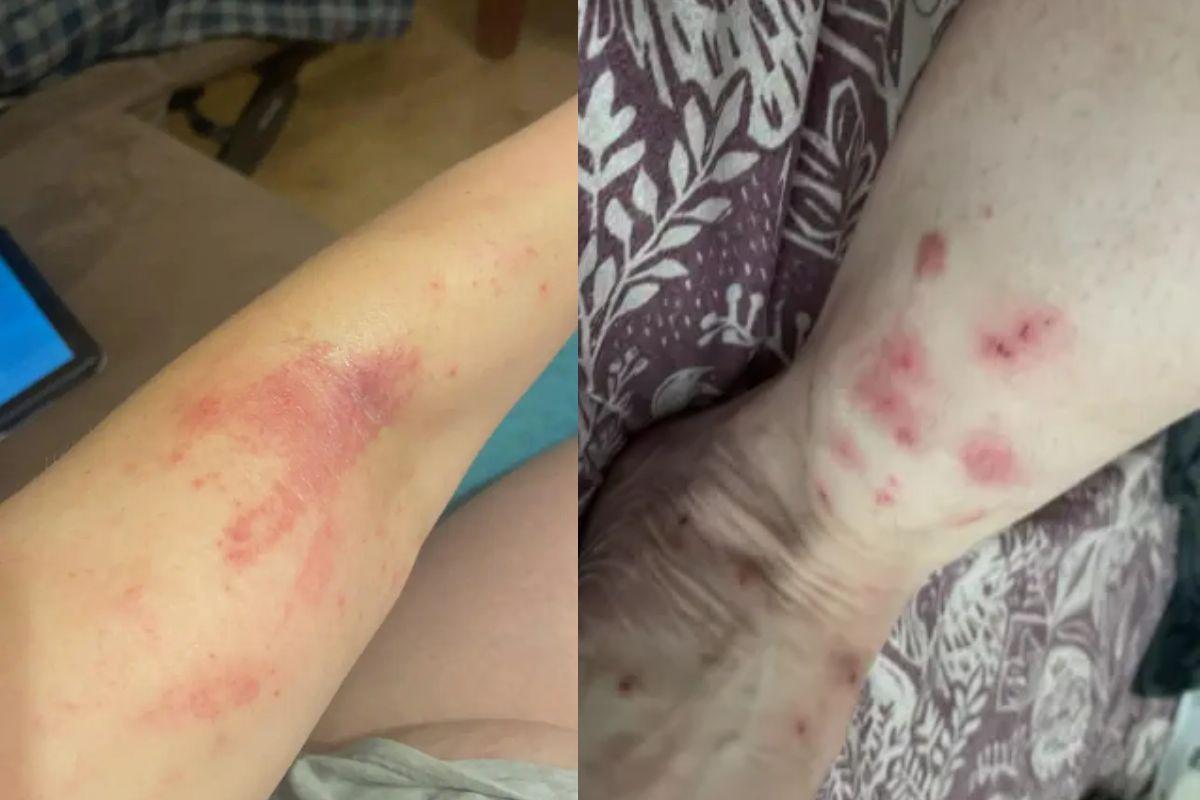 Hematomas foram se espalhando pelo corpo