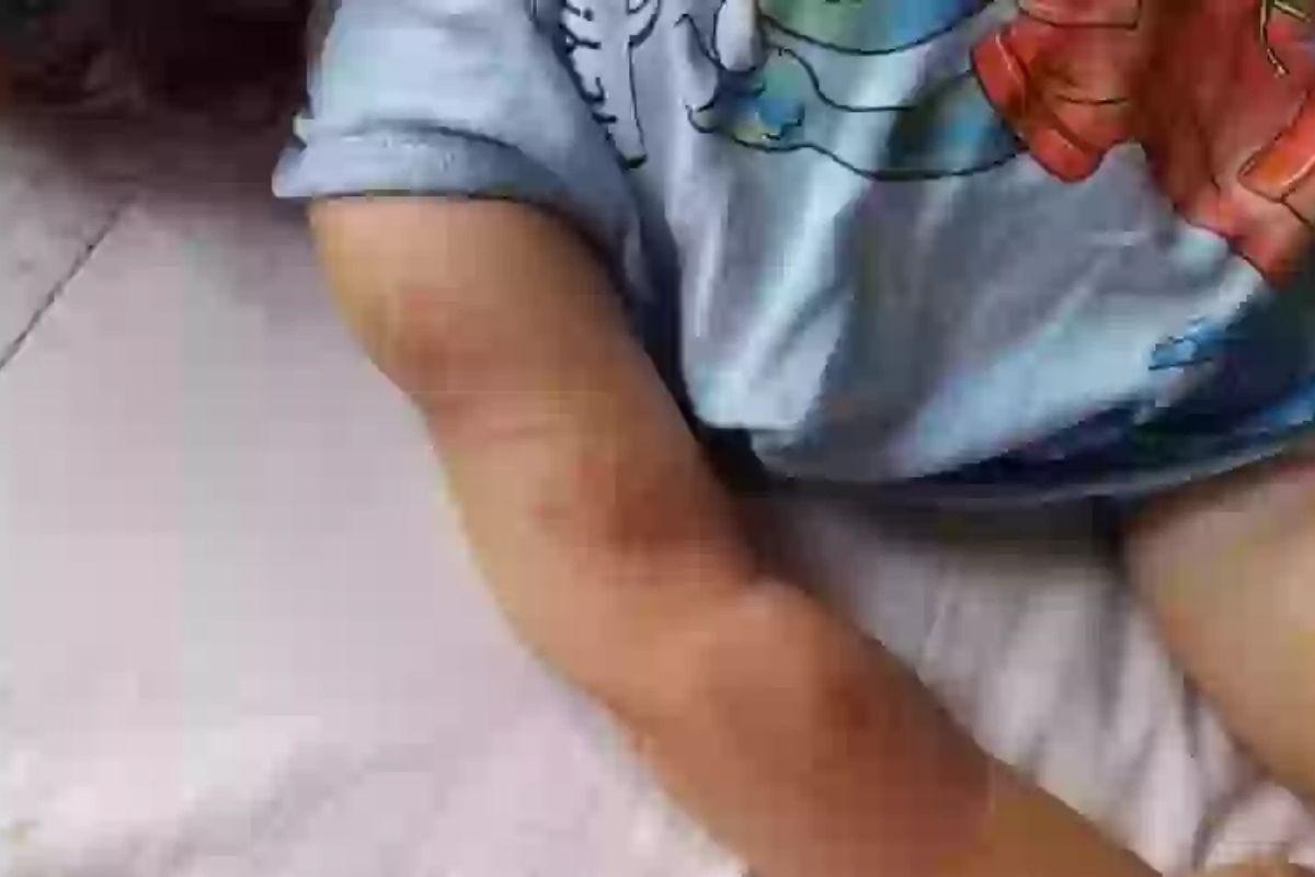 Bebê de um ano recebe mordida de colega e professora é afastada da escola