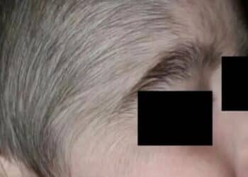 Bebê tem crescimento anormal de pelos após pai usar minoxidil