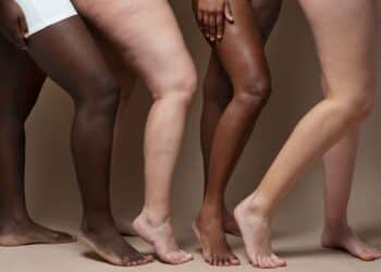 Lipedema: entenda a condição que afeta milhares de mulheres
