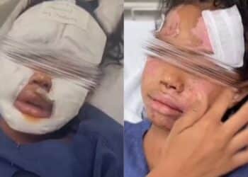 Pediatra mostra rosto de criança após ‘trend’ famosa do ovo: “Explodiram na minha cara”