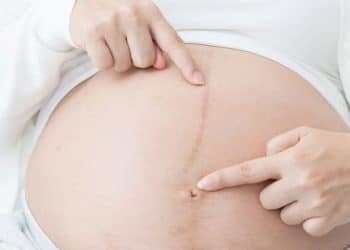 O que é a linha Nigra e por que ela aparece?"