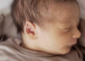 Hipertricose em bebês: o que você saber sobre o uso de minoxidil