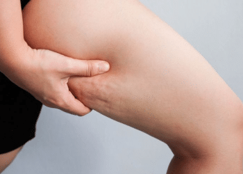 Celulite tem solução? Descubra os segredos que realmente funcionam!