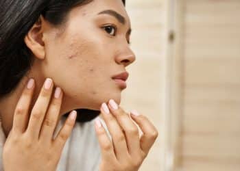 Espinhas internas, por que surgem e como acabar com elas?