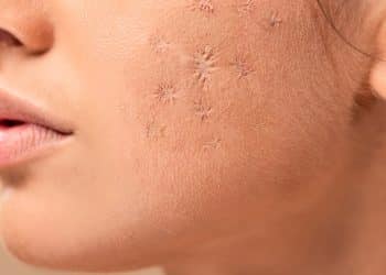 Os Tratamentos Mais Poderosos Contra Manchas na Pele que Você Precisa Conhecer!