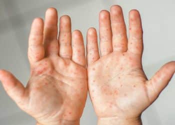 Doença mão-pé-boca: sintomas, transmissão e como proteger as crianças