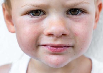 Doença mão-pé-boca: sintomas, transmissão e como proteger as crianças