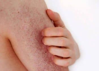 Bolinhas na pele: o que é a queratose pilar e como tratar?