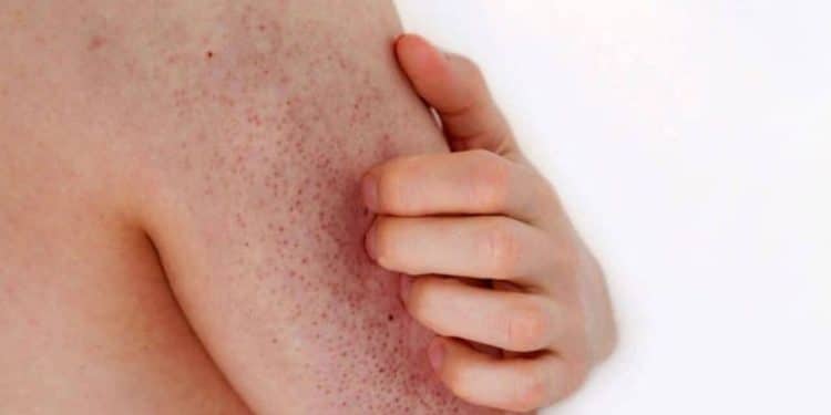 Bolinhas na pele: o que é a queratose pilar e como tratar?