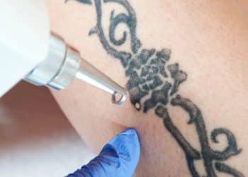 A remoção de tatuagens, é possível apagar completamente?