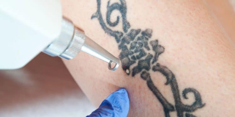 A remoção de tatuagens, é possível apagar completamente?