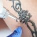 A remoção de tatuagens, é possível apagar completamente?
