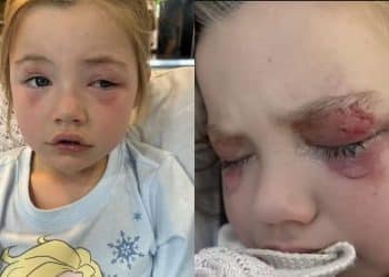 Menina de 4 anos perde a visão após mexer com produto de limpeza tóxico