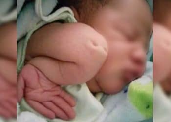 Bebê portador de condição rara nasce com os ombros virados para baixo e cotovelos virados para cima