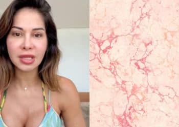 Trombofilia na gravidez: entenda condição de Maíra Cardi