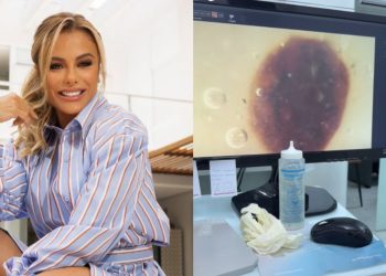 Poliana Rocha encontra pinta suspeita na mão e revela diagnóstico após consulta médica