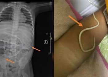 Criança vomita vermes logo após ser diagnosticado com prisão de ventre