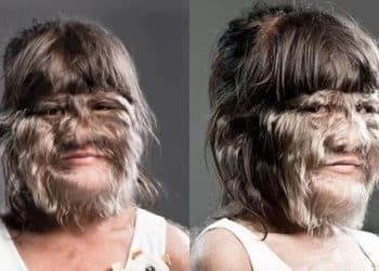 Saiba a história da adolescente considerada a “mais peluda do mundo” e veja como ela está agora