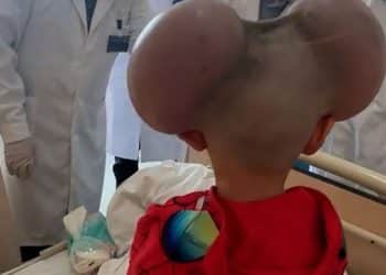 Menino alvo de bullying por condição rara passa por cirurgia e resultado emociona