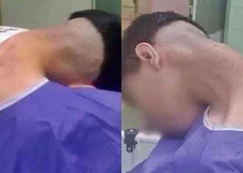 Homem desenvolve ‘Síndrome da cabeça caída’ e alerta para risco pouco conhecido