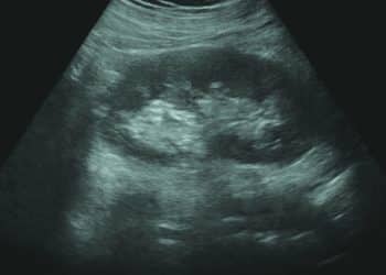 Grávida esperava gêmeos, mas só recebeu um bebê e caso gera investigação