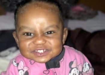 Criança de 2 anos sofre queimaduras e traumatismo craniano após ser deixada com a babá