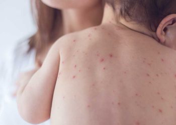 Catapora em bebês: saiba identificar sintomas, formas de prevenção e tratamento