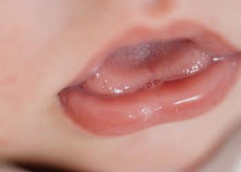 Língua presa em recém-nascidos: tudo sobre a frenectomia