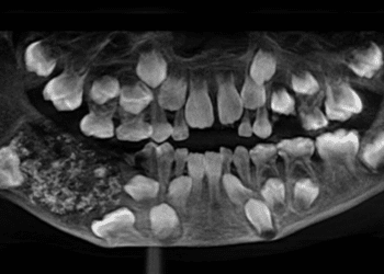 Menino de 7 anos tem 526 dentes retirados em cirurgia na Índia