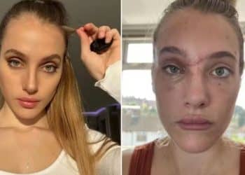 Modelo sofre acidente de moto após ser atingida por ave e agora luta contra perda de memória