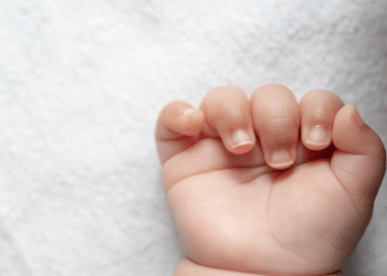 Pele vermelha e irritada pode ser dermatite infantil