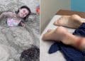 Menina de 8 anos é atacada por tubarão em praia no Texas e passa por cirurgia
