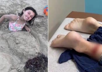 Menina de 8 anos é atacada por tubarão em praia no Texas e passa por cirurgia