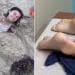Menina de 8 anos é atacada por tubarão em praia no Texas e passa por cirurgia