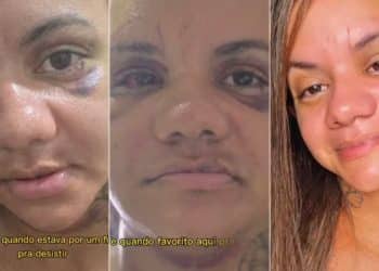 Mulher que foi agredida com 60 socos por ex-namorado mostra evolução da recuperação de cirurgia